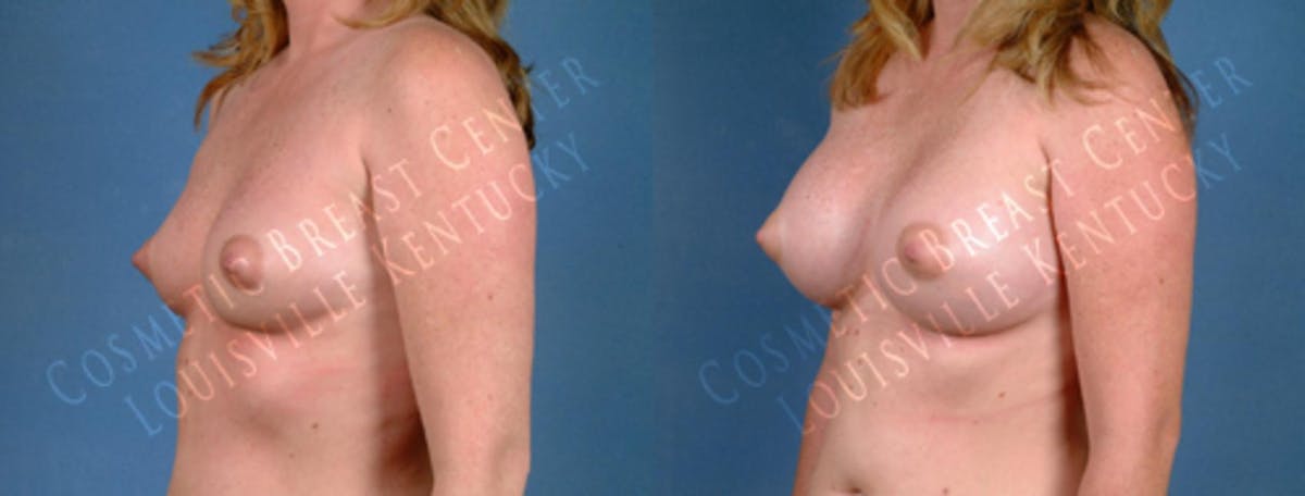 Enlargement - Saline Before & After Gallery - Patient 283004 - Image 2