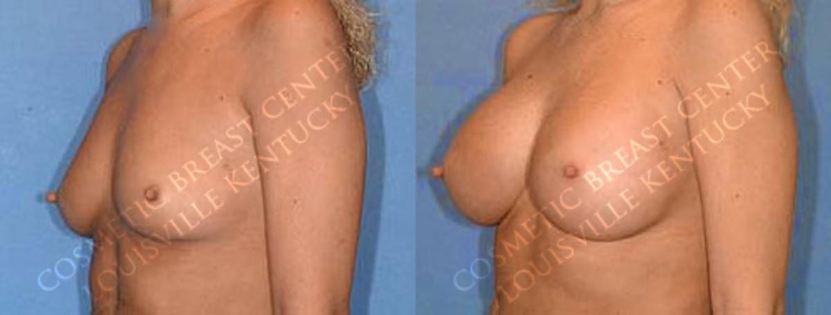 Enlargement - Saline Before & After Gallery - Patient 174787 - Image 2