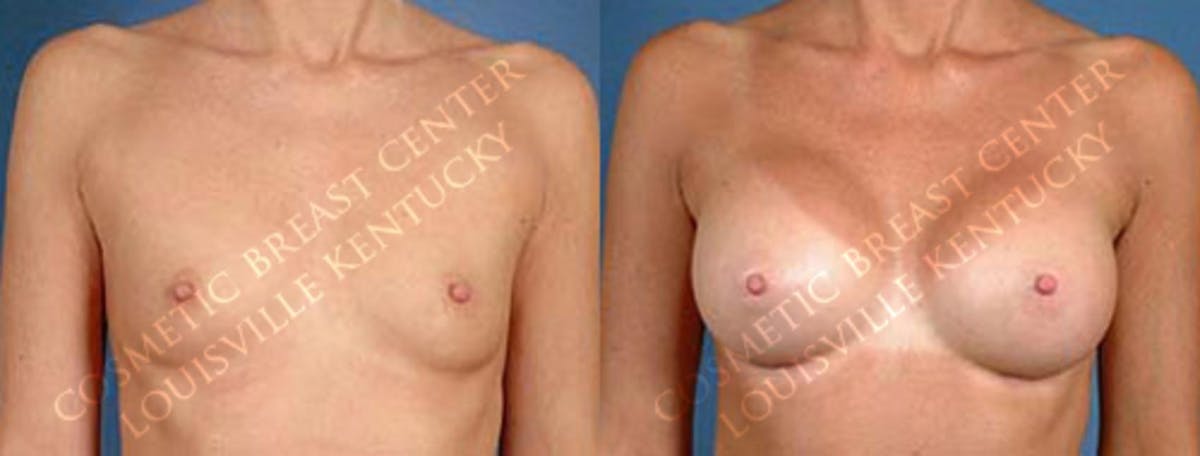 Enlargement - Saline Before & After Gallery - Patient 105205 - Image 1