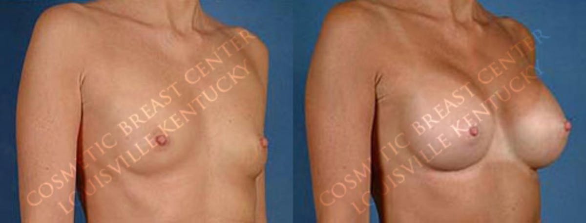 Enlargement - Saline Before & After Gallery - Patient 105205 - Image 2