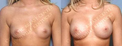 Enlargement - Saline Before & After Gallery - Patient 839282 - Image 1
