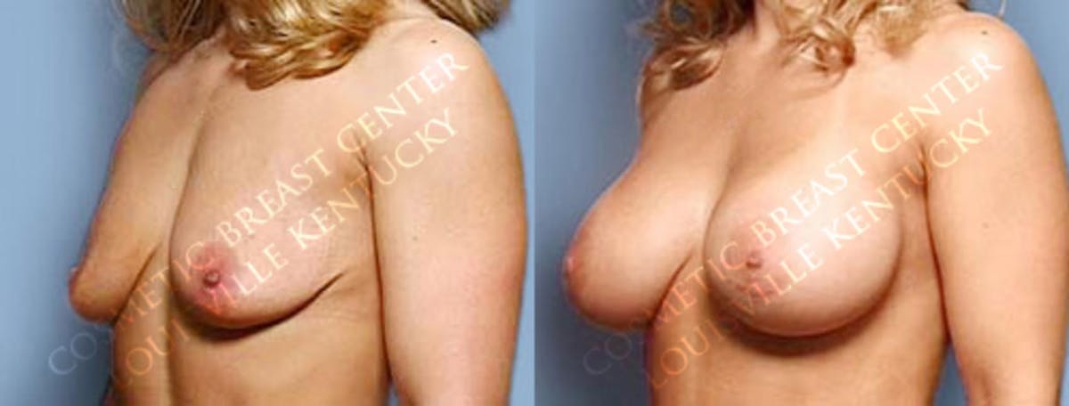 Enlargement - Saline Before & After Gallery - Patient 770063 - Image 2