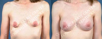 Enlargement - Saline Before & After Gallery - Patient 813682 - Image 1