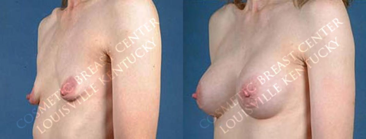 Enlargement - Saline Before & After Gallery - Patient 813682 - Image 2