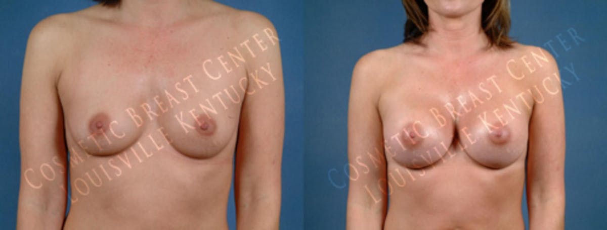 Enlargement - Saline Before & After Gallery - Patient 239295 - Image 1