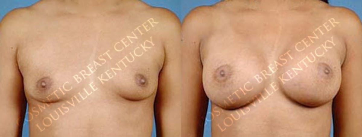 Enlargement - Saline Before & After Gallery - Patient 123162 - Image 1