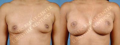 Enlargement - Saline Before & After Gallery - Patient 123162 - Image 1