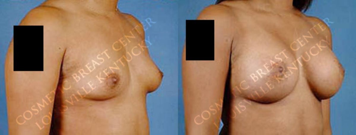 Enlargement - Saline Before & After Gallery - Patient 123162 - Image 2