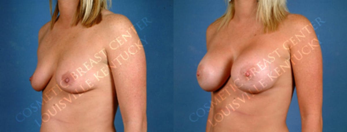 Enlargement - Saline Before & After Gallery - Patient 364930 - Image 2