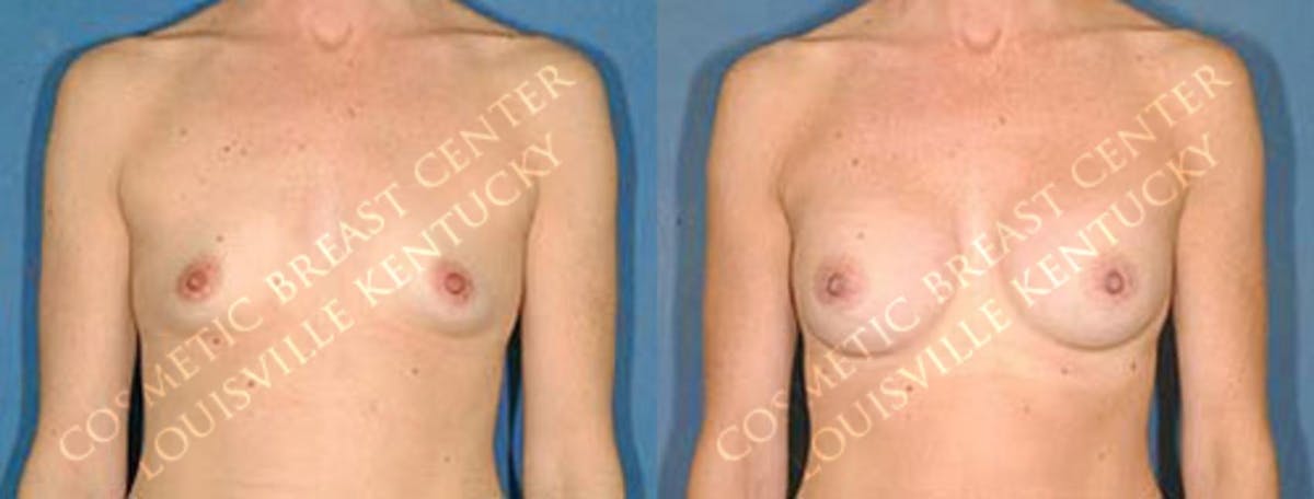 Enlargement - Saline Before & After Gallery - Patient 288501 - Image 1