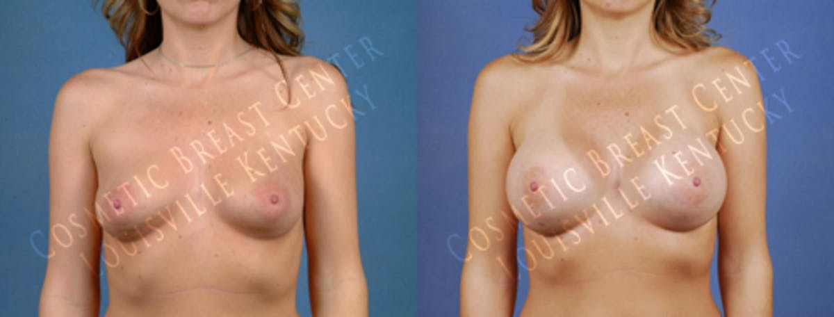 Enlargement - Saline Before & After Gallery - Patient 233925 - Image 1