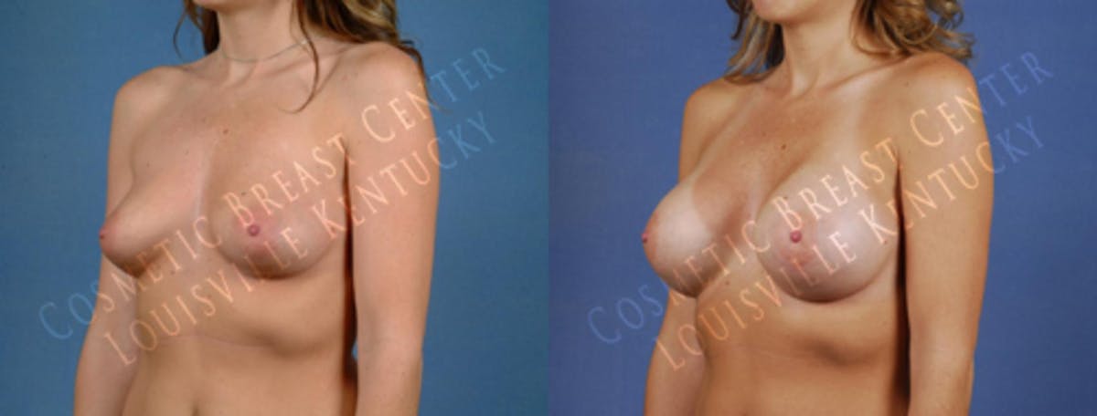 Enlargement - Saline Before & After Gallery - Patient 233925 - Image 2