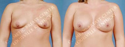 Enlargement - Saline Before & After Gallery - Patient 124564 - Image 1