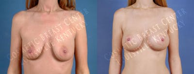Enlargement - Saline Before & After Gallery - Patient 179791 - Image 1