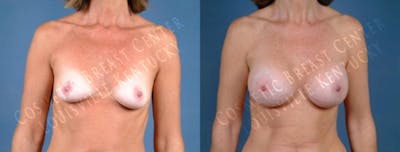 Enlargement - Saline Before & After Gallery - Patient 763933 - Image 1