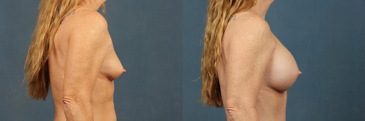 Enlargement - Silicone Before & After Gallery - Patient 206580 - Image 3