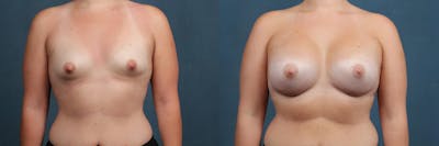 Enlargement - Silicone Before & After Gallery - Patient 123592 - Image 1