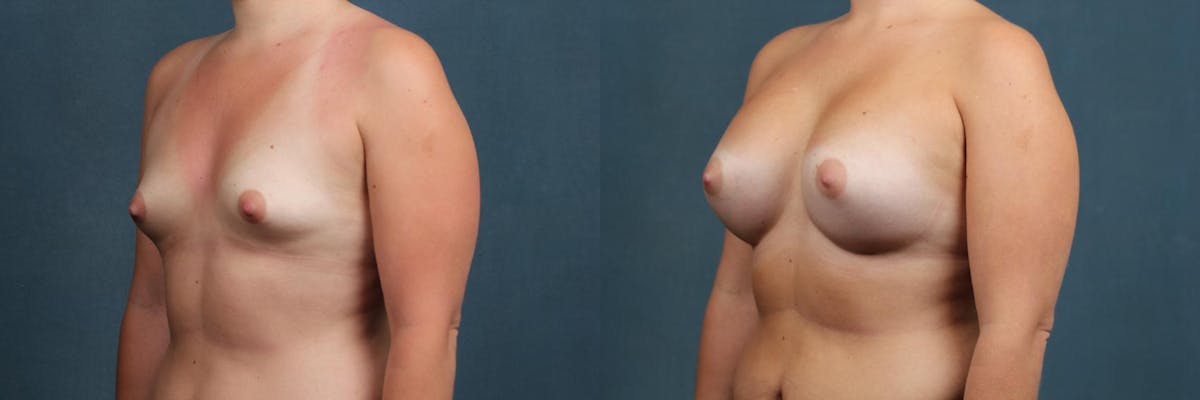 Enlargement - Silicone Before & After Gallery - Patient 123592 - Image 2