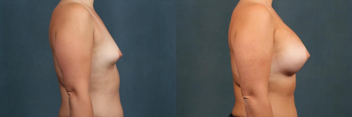Enlargement - Silicone Before & After Gallery - Patient 123592 - Image 3