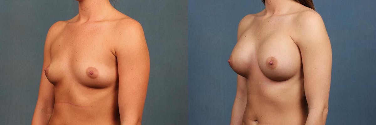 Enlargement - Silicone Before & After Gallery - Patient 310446 - Image 2