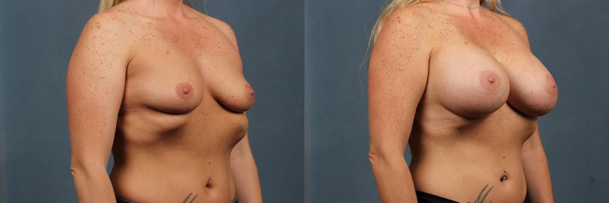 Enlargement - Silicone Before & After Gallery - Patient 410610 - Image 2