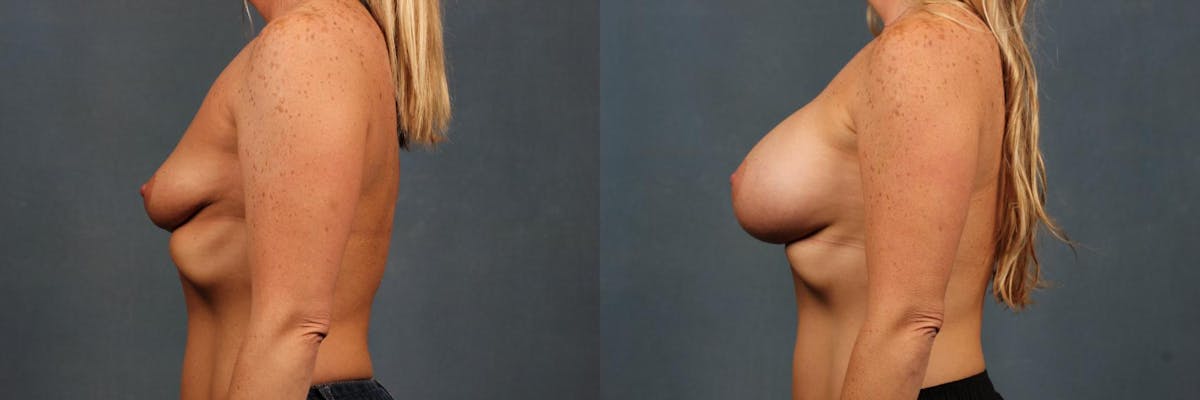 Enlargement - Silicone Before & After Gallery - Patient 410610 - Image 3