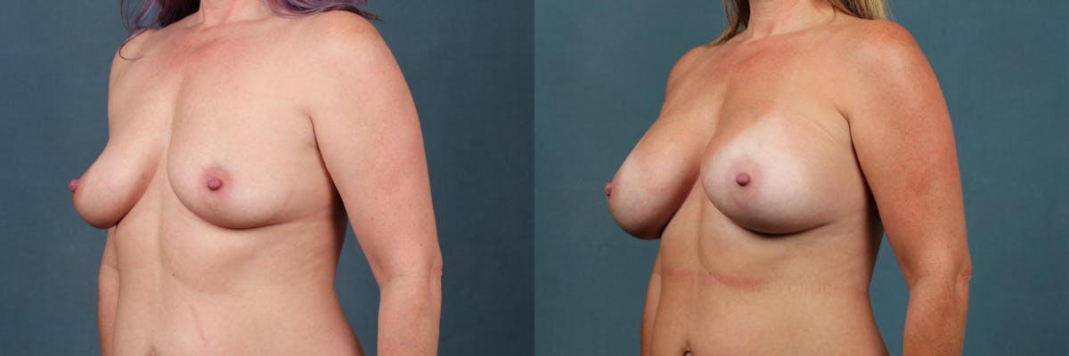 Enlargement - Silicone Before & After Gallery - Patient 418962 - Image 2