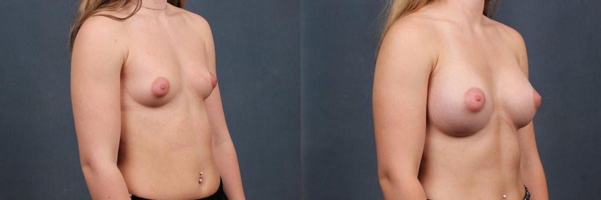 Enlargement - Silicone Before & After Gallery - Patient 429141 - Image 3