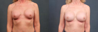 Enlargement - Silicone Before & After Gallery - Patient 140608 - Image 1