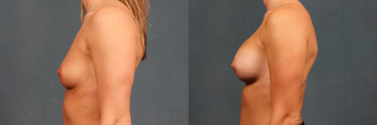 Enlargement - Silicone Before & After Gallery - Patient 299626 - Image 3