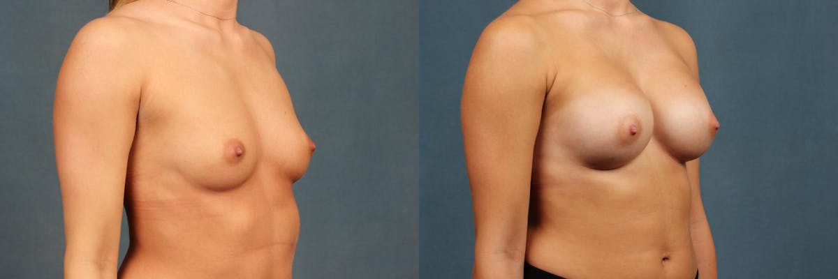 Enlargement - Silicone Before & After Gallery - Patient 299626 - Image 4