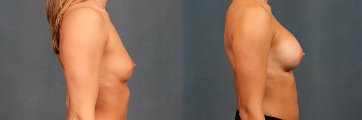 Enlargement - Silicone Before & After Gallery - Patient 299626 - Image 5