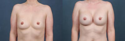 Enlargement - Silicone Before & After Gallery - Patient 291311 - Image 1