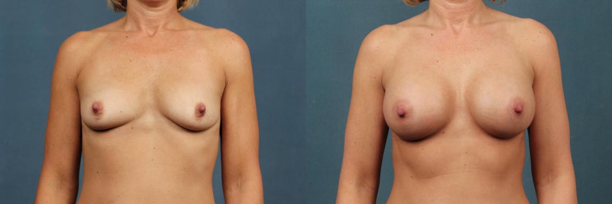 Enlargement - Silicone Before & After Gallery - Patient 140191 - Image 1
