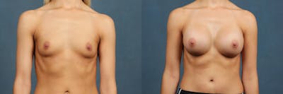 Enlargement - Silicone Before & After Gallery - Patient 991426 - Image 1