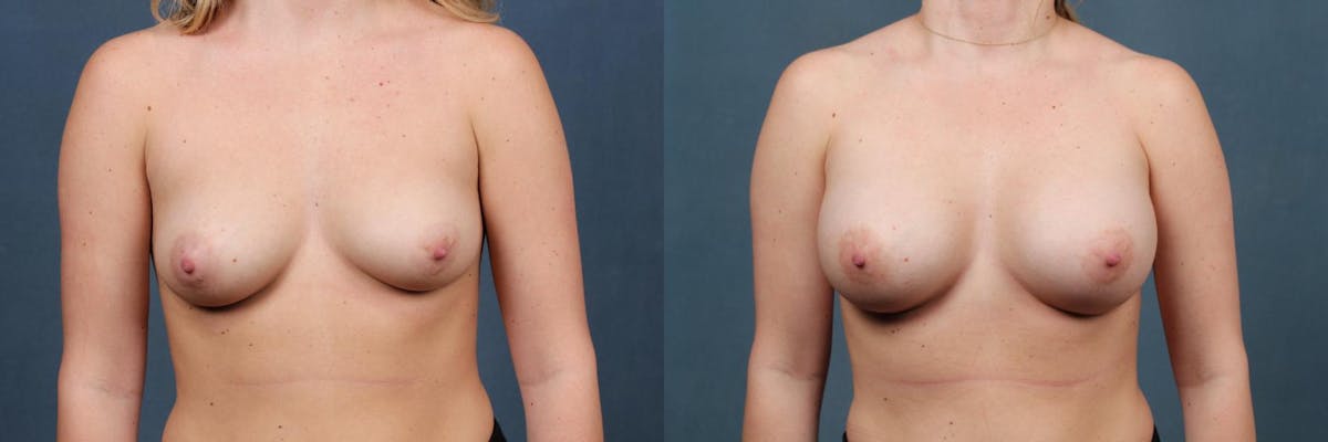 Enlargement - Silicone Before & After Gallery - Patient 392929 - Image 1