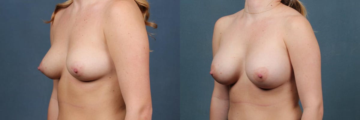 Enlargement - Silicone Before & After Gallery - Patient 392929 - Image 2