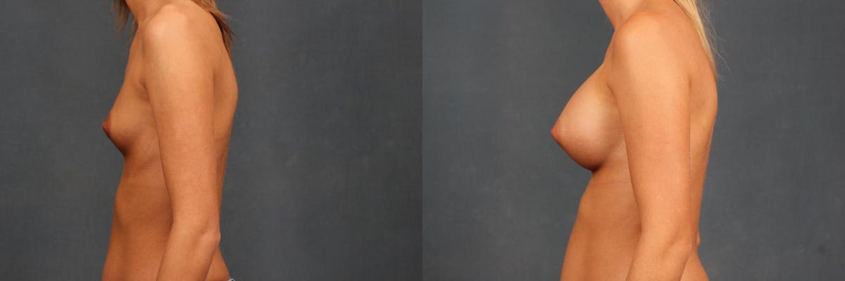 Enlargement - Silicone Before & After Gallery - Patient 115812 - Image 2