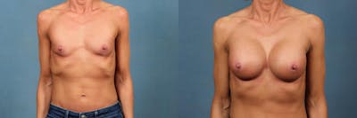 Enlargement - Silicone Before & After Gallery - Patient 166260 - Image 1