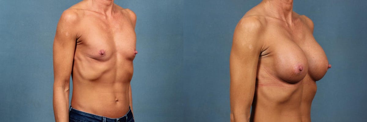 Enlargement - Silicone Before & After Gallery - Patient 166260 - Image 2
