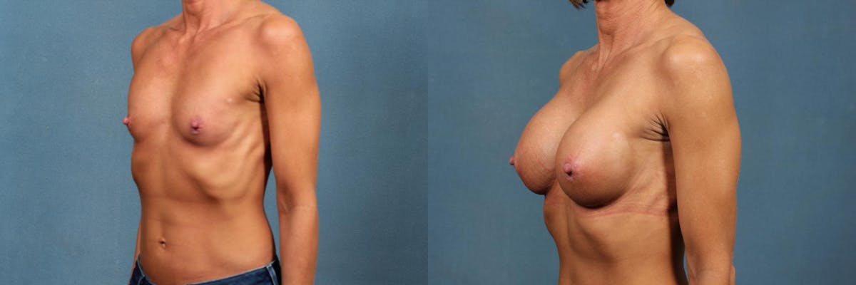 Enlargement - Silicone Before & After Gallery - Patient 166260 - Image 3