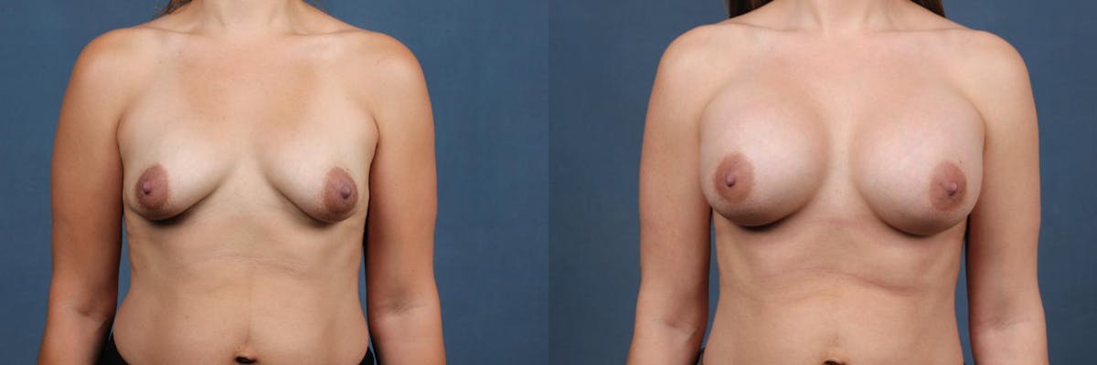 Enlargement - Silicone Before & After Gallery - Patient 395984 - Image 1