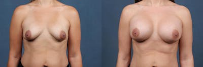 Enlargement - Silicone Before & After Gallery - Patient 395984 - Image 1
