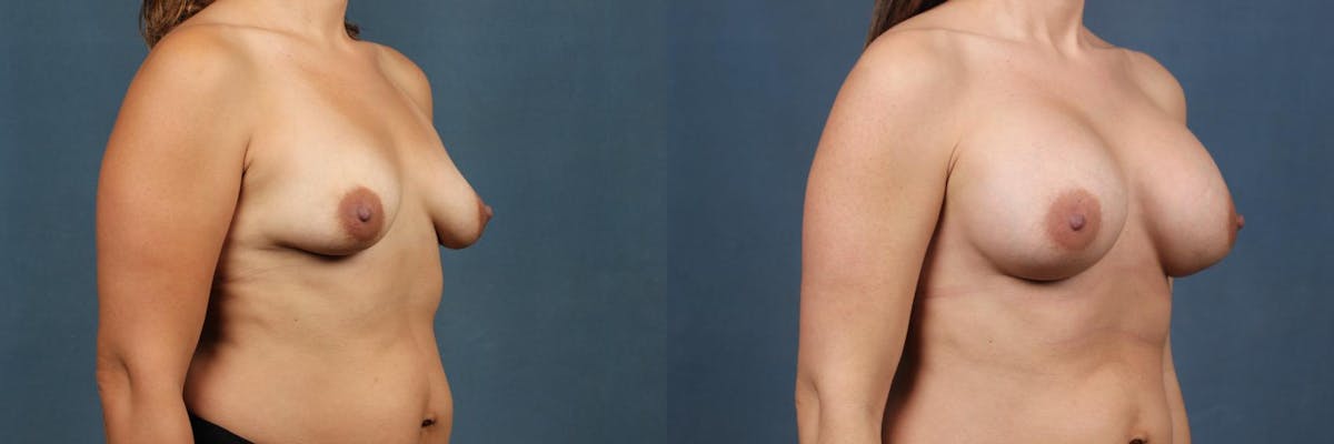 Enlargement - Silicone Before & After Gallery - Patient 395984 - Image 2