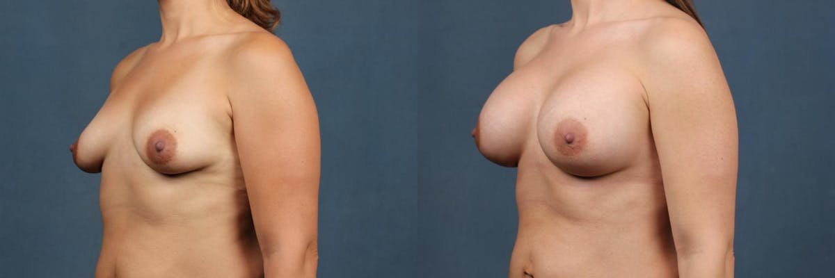 Enlargement - Silicone Before & After Gallery - Patient 395984 - Image 3