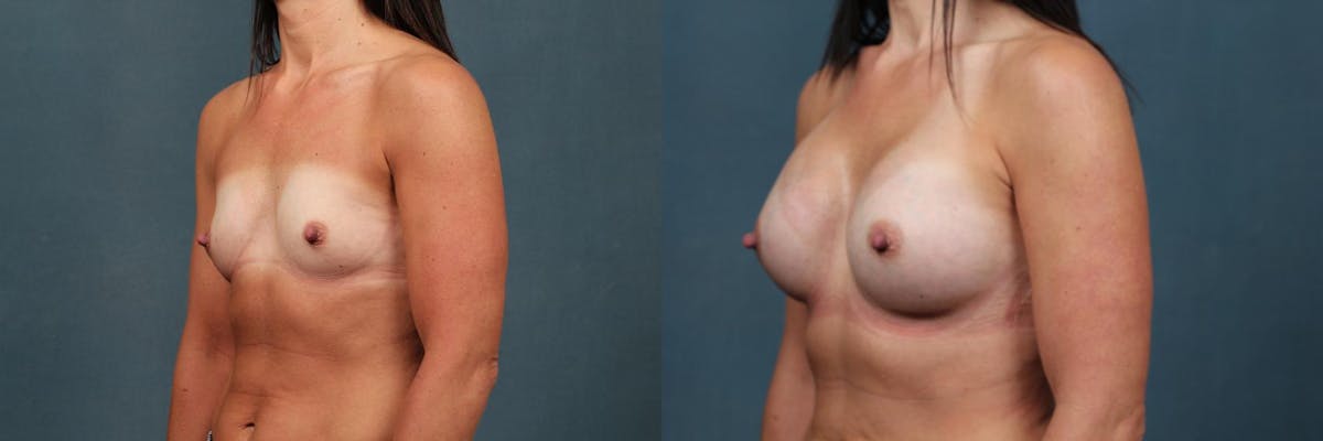 Enlargement - Silicone Before & After Gallery - Patient 329175 - Image 2
