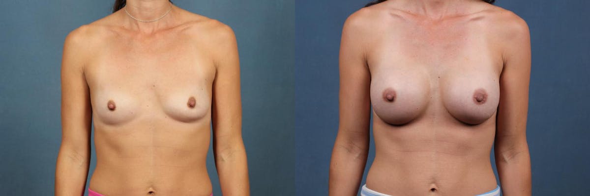 Enlargement - Silicone Before & After Gallery - Patient 122578 - Image 1