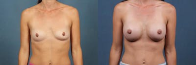Enlargement - Silicone Before & After Gallery - Patient 122578 - Image 1