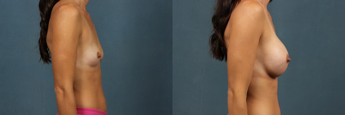 Enlargement - Silicone Before & After Gallery - Patient 122578 - Image 5