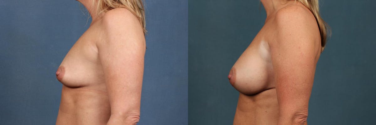 Enlargement - Silicone Before & After Gallery - Patient 179262 - Image 3
